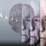 Болезнь Альцгеймера по глазам