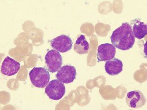 Лейкоз геморрагический анемия тромбоцитопения