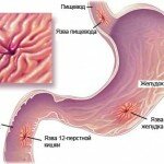 Эрозивные повреждения желудка и тонкого кишечника (гастродуоденальные эрозии)